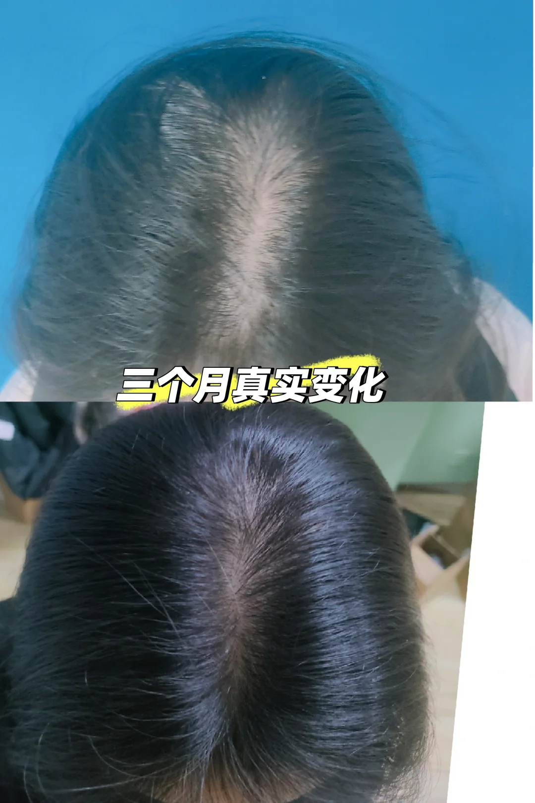 斑秃中医怎么治疗？新加坡贡方堂TCM陈慧芳一方让头发重现生机